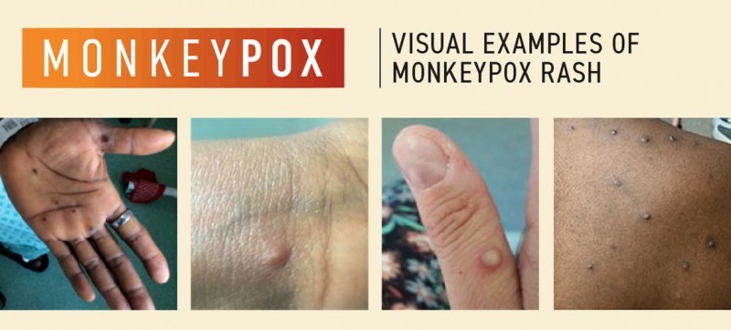 Monkeypox declared a global health emergency by the World Health Organization